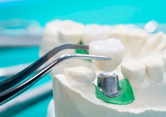Implante de diente